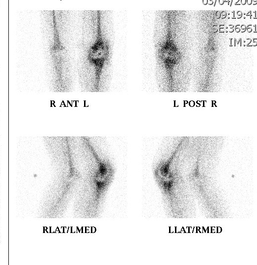 Gallium Scan